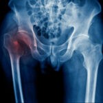 Hip Fracture