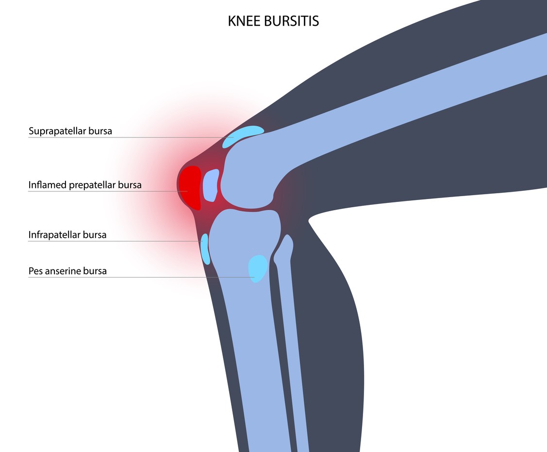 Knee Tendon Bursitis