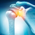 Rotator cuff tears