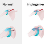 Shoulder impingement syndrome